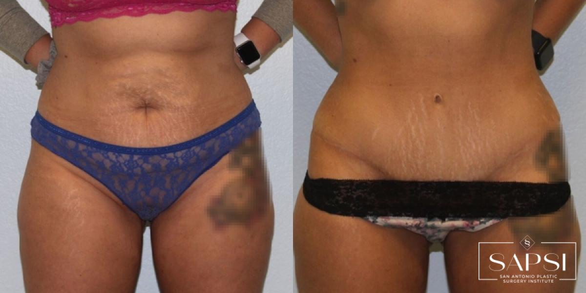 Tummy Tuck: Patient 10 - Before and After 3