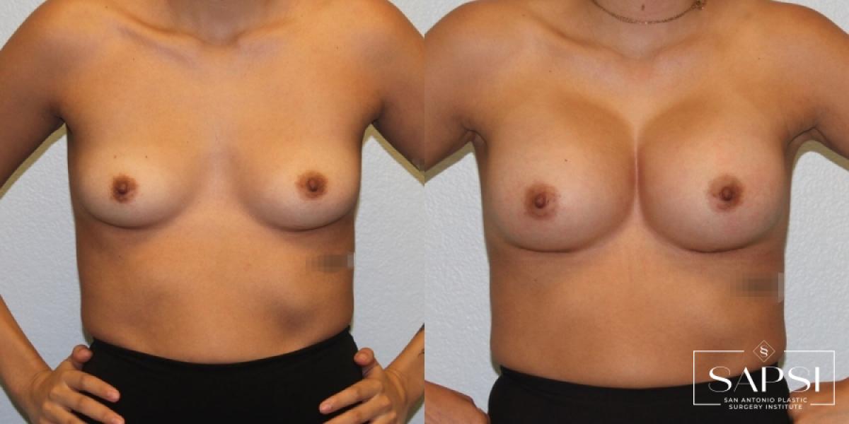 Breast Augmentation: Patient 29 - Before and After 1