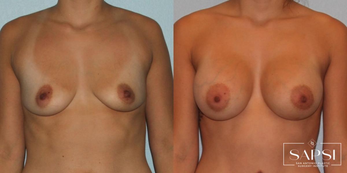 Breast Augmentation: Patient 81 - Before and After 1