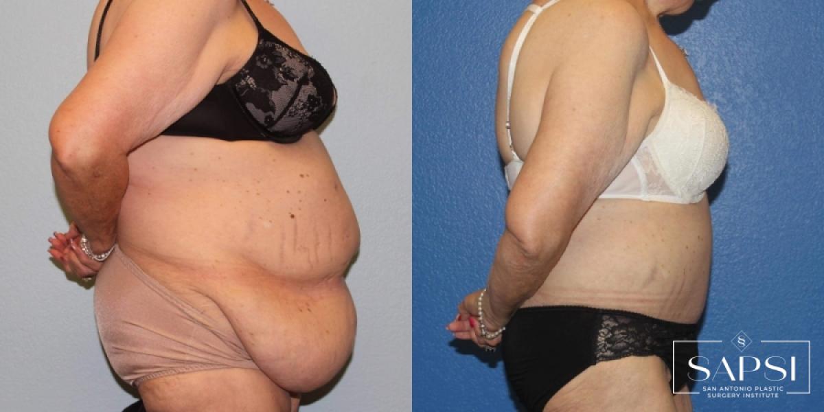 Tummy Tuck: Patient 48 - Before and After 3