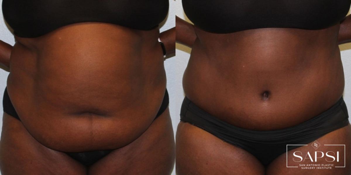 Tummy Tuck: Patient 22 - Before and After 1