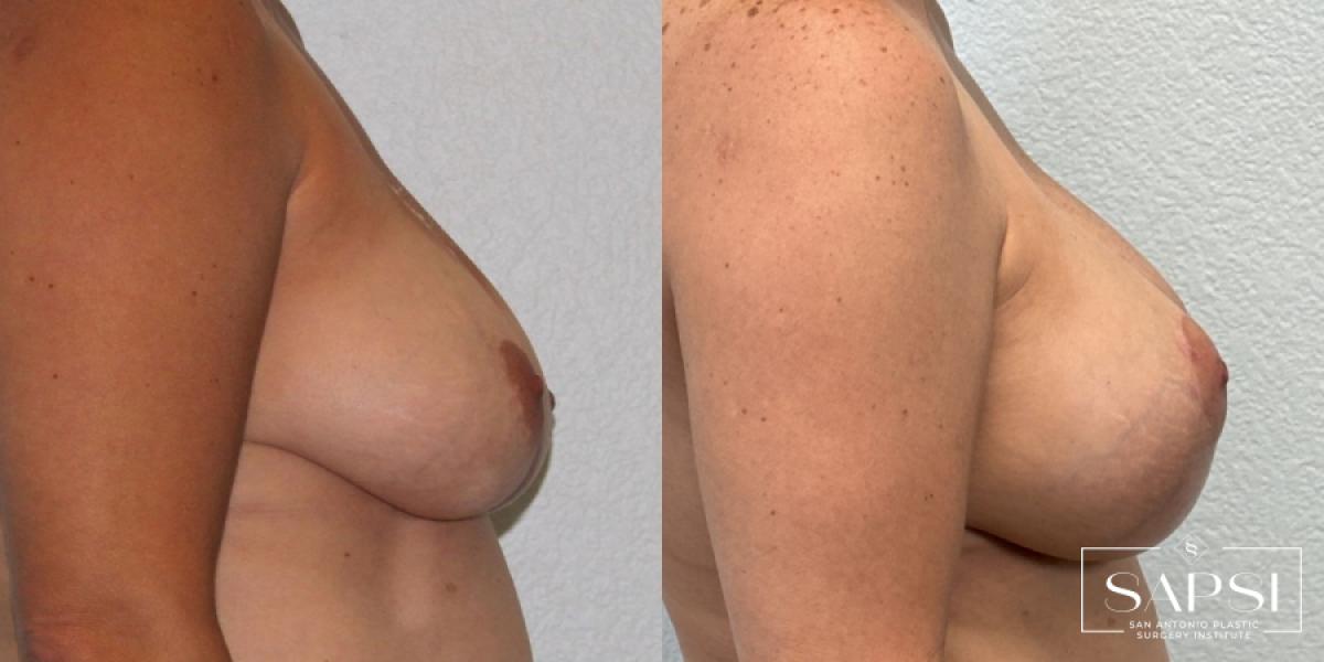 Breast Augmentation With Lift: Patient 20 - Before and After 3