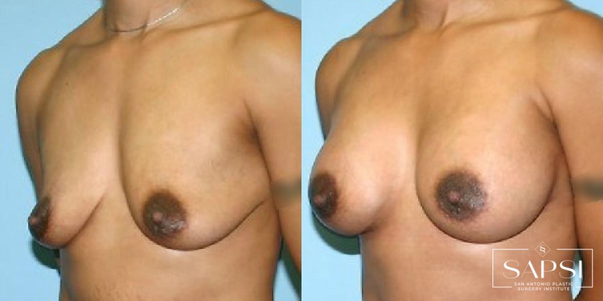 Breast Augmentation: Patient 3 - Before and After 2