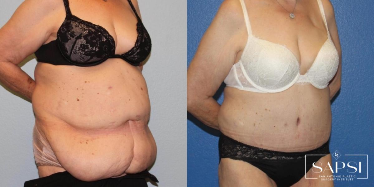 Tummy Tuck: Patient 48 - Before and After 2