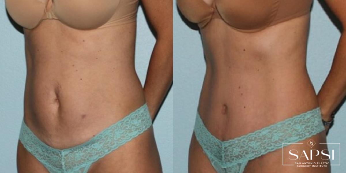 Tummy Tuck: Patient 29 - Before and After 2