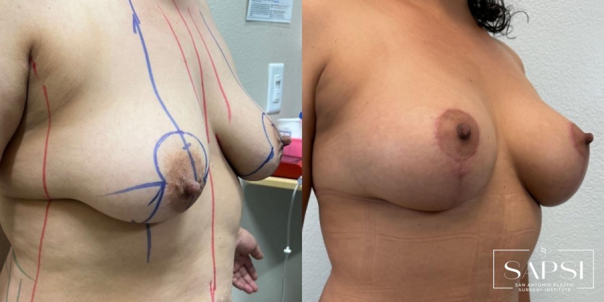 Breast Augmentation With Lift: Patient 23 - Before and After 2