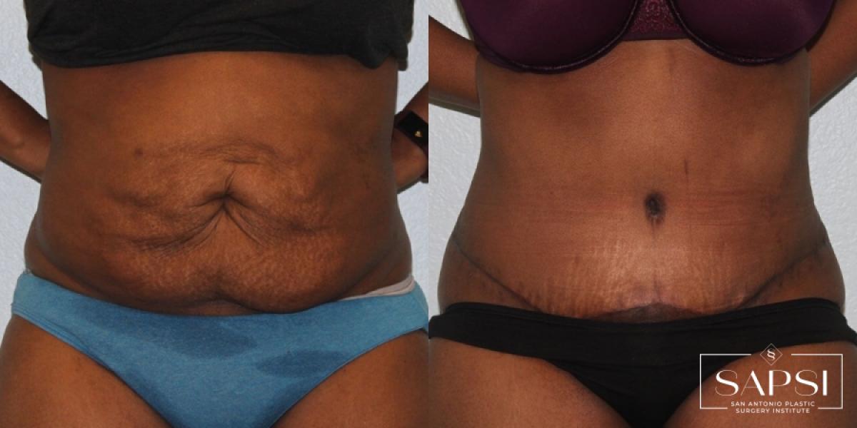 Tummy Tuck: Patient 25 - Before and After 1