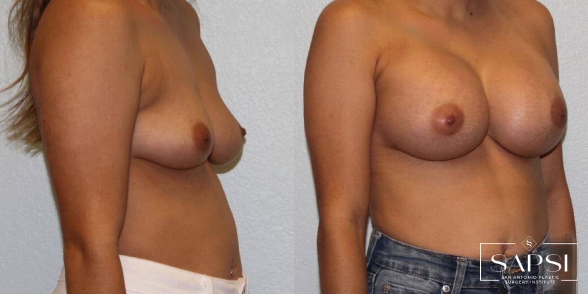 Breast Augmentation: Patient 28 - Before and After 2