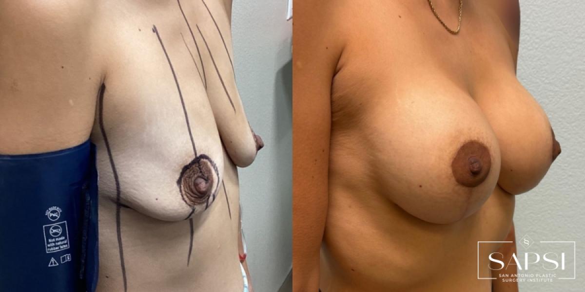 Breast Augmentation With Lift: Patient 22 - Before and After 3