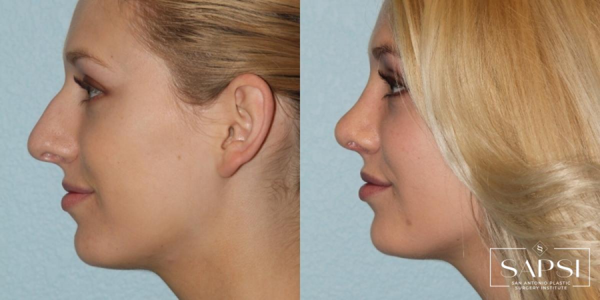 Facelift: Patient 2 - Before and After 2