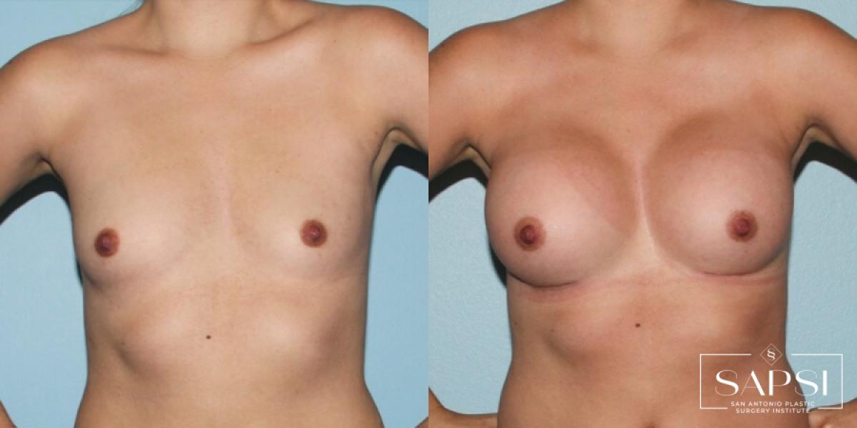 Breast Augmentation: Patient 8 - Before and After  