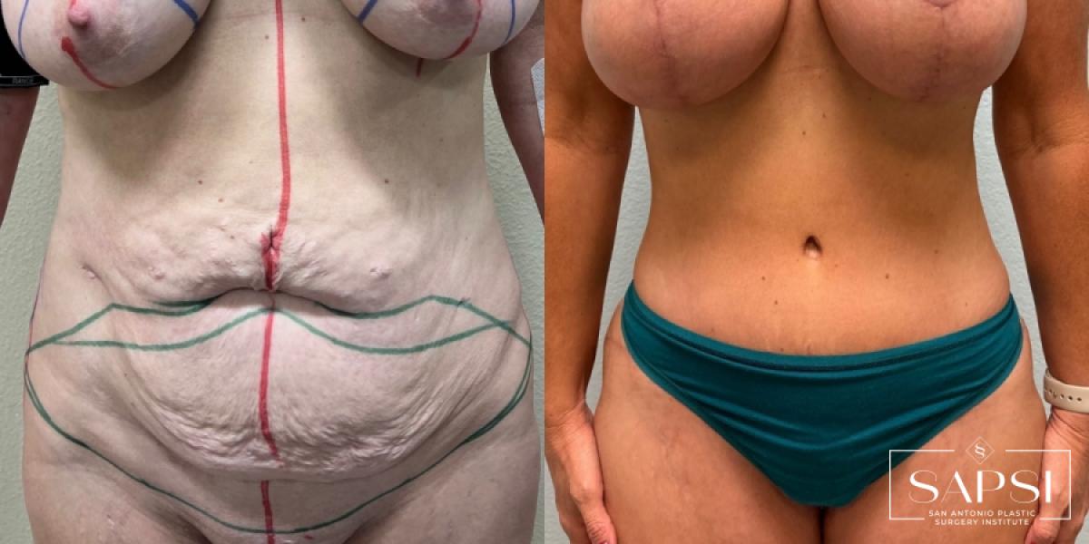 Tummy Tuck: Patient 1 - Before and After  