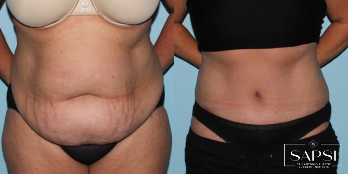 Tummy Tuck: Patient 30 - Before and After 1