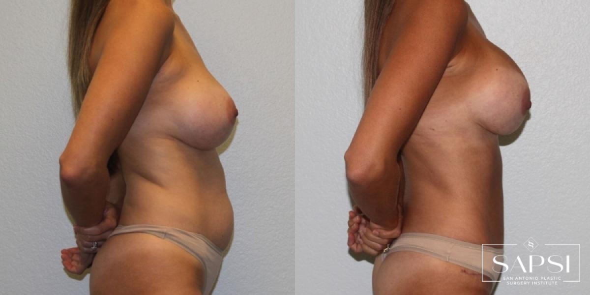 Breast Revision: Patient 5 - Before and After 3