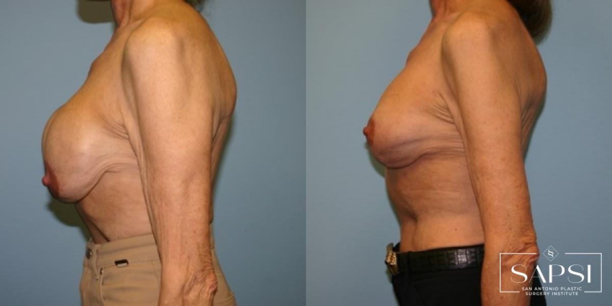 Breast Revision: Patient 9 - Before and After 3