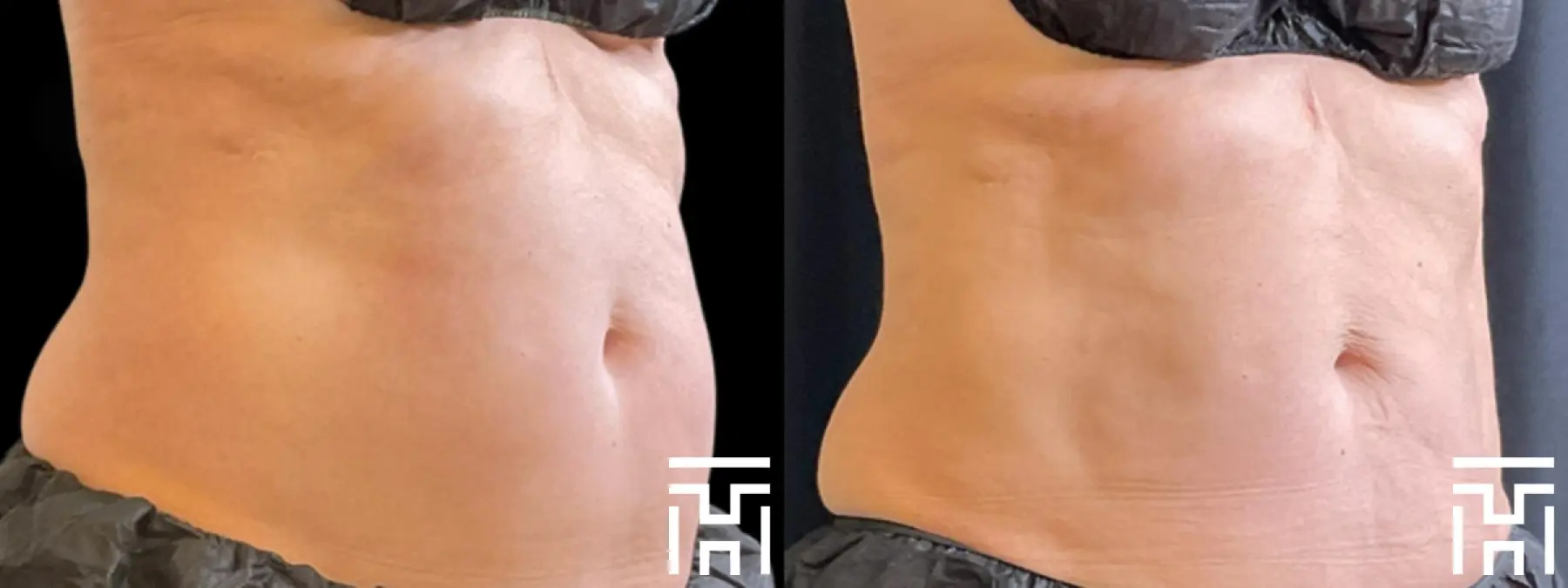 CoolSculpting®: Patient 3 - Before and After  