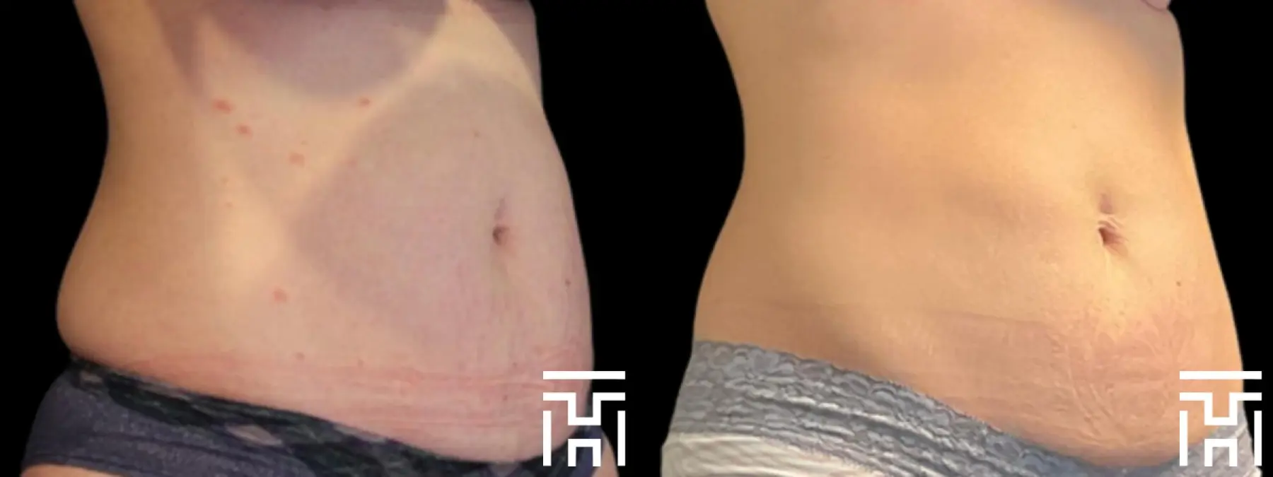 CoolSculpting®: Patient 1 - Before and After  