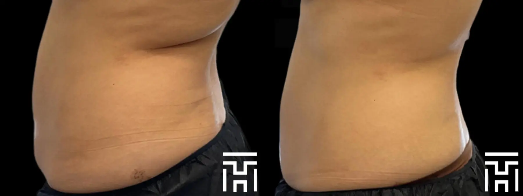 CoolSculpting®: Patient 2 - Before and After  