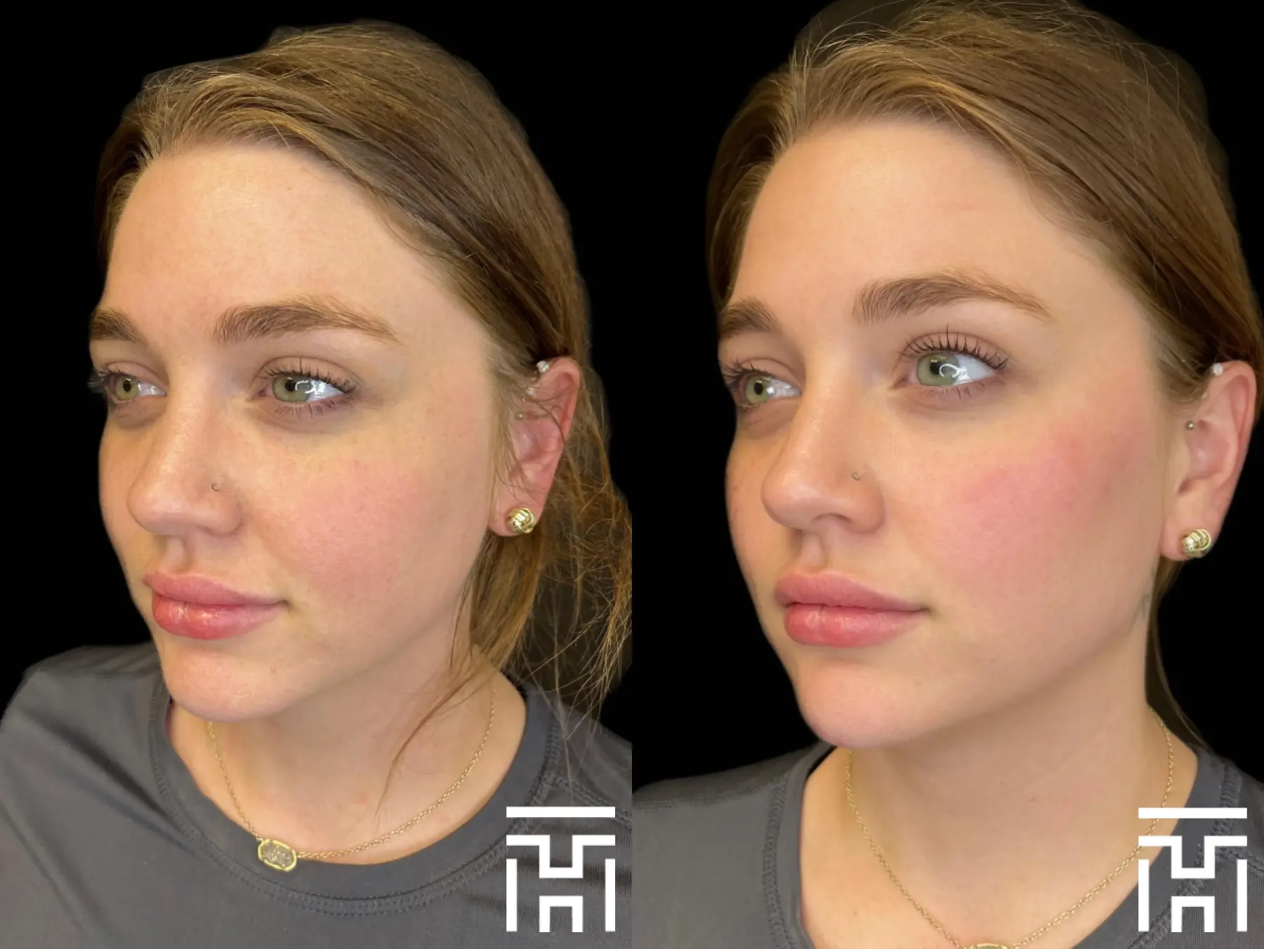 Facial Rebalancing : Patient 1 - Before and After  