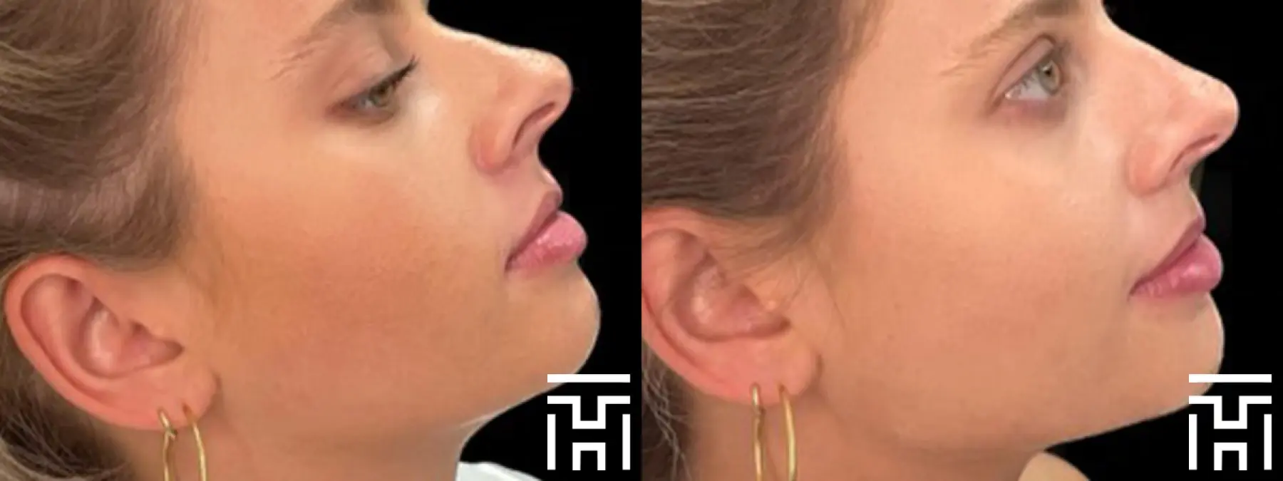 Fillers: Patient 4 - Before and After  