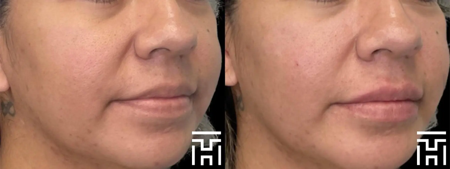 Fillers: Patient 1 - Before and After  