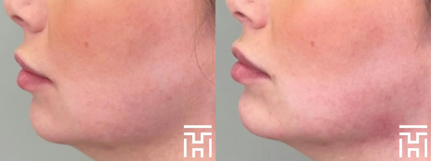 Fillers: Patient 6 - Before and After  