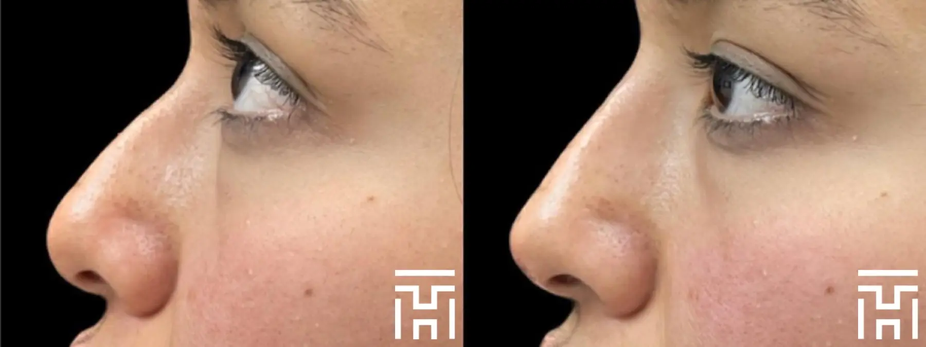 Fillers: Patient 3 - Before and After  