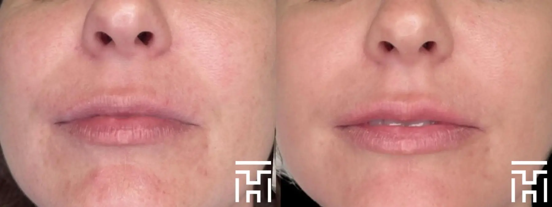 Fillers: Patient 7 - Before and After  