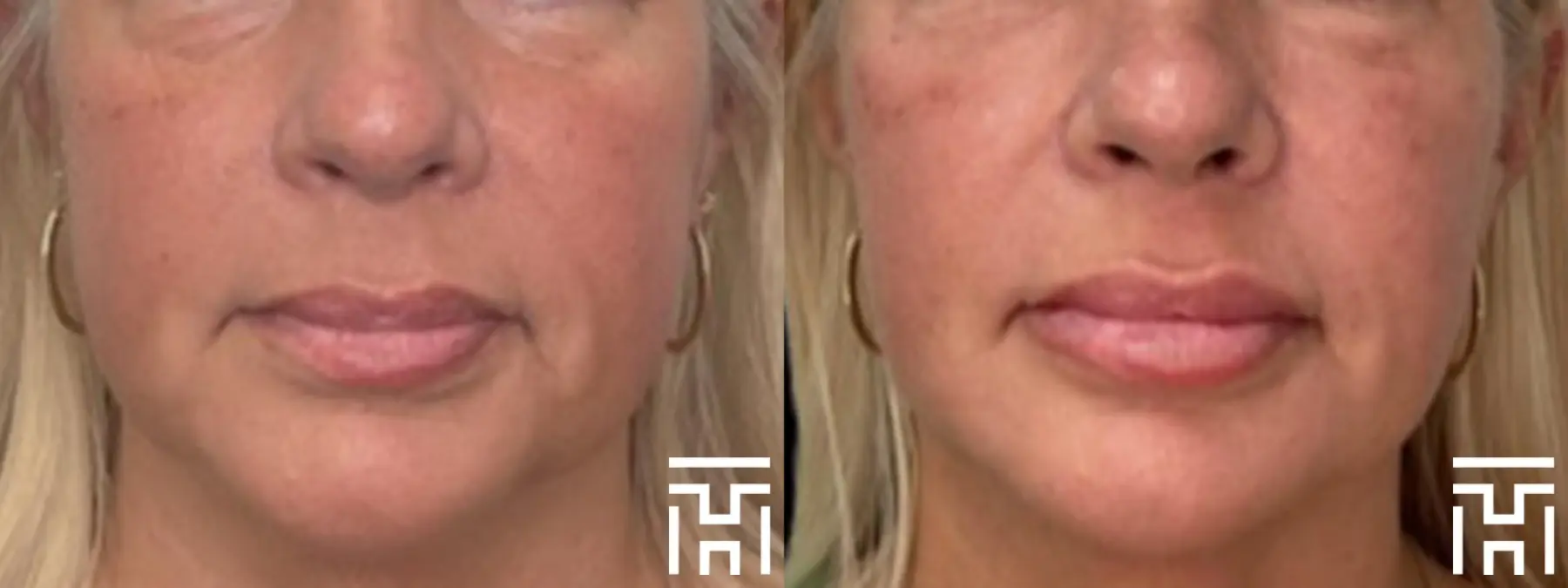 Fillers: Patient 5 - Before and After  