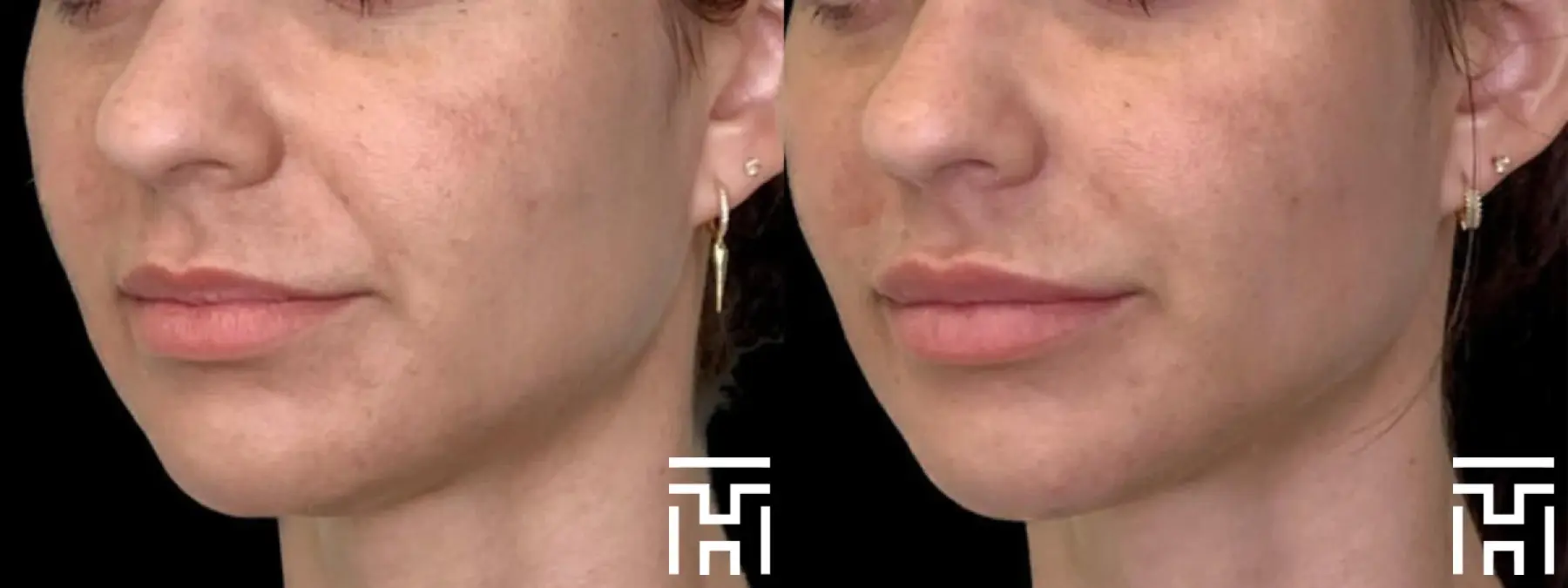 Fillers: Patient 2 - Before and After  