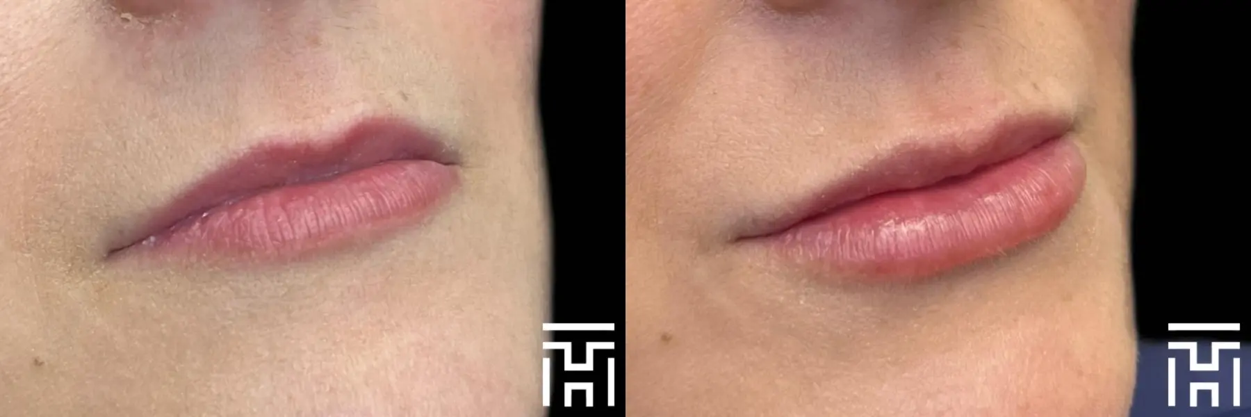 Lip Fillers: Patient 8 - Before and After  