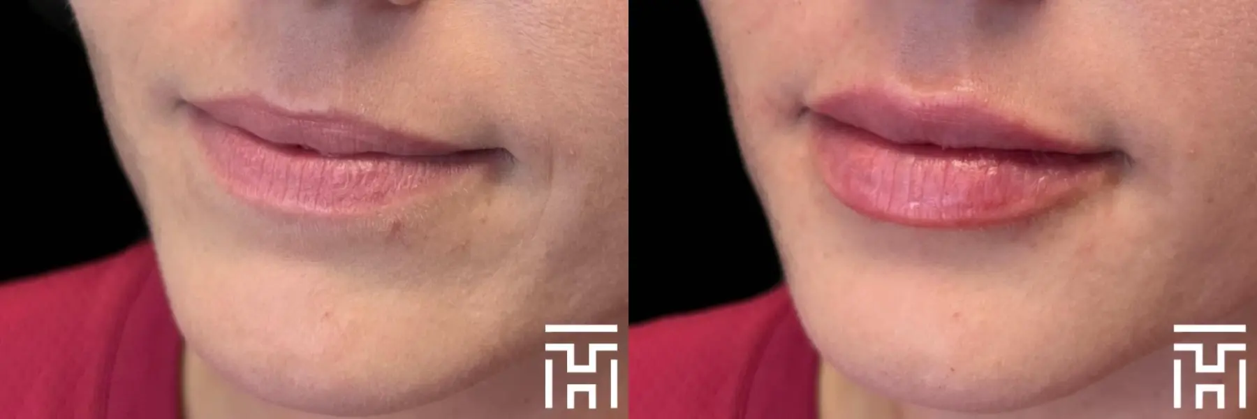 Lip Fillers: Patient 7 - Before and After  