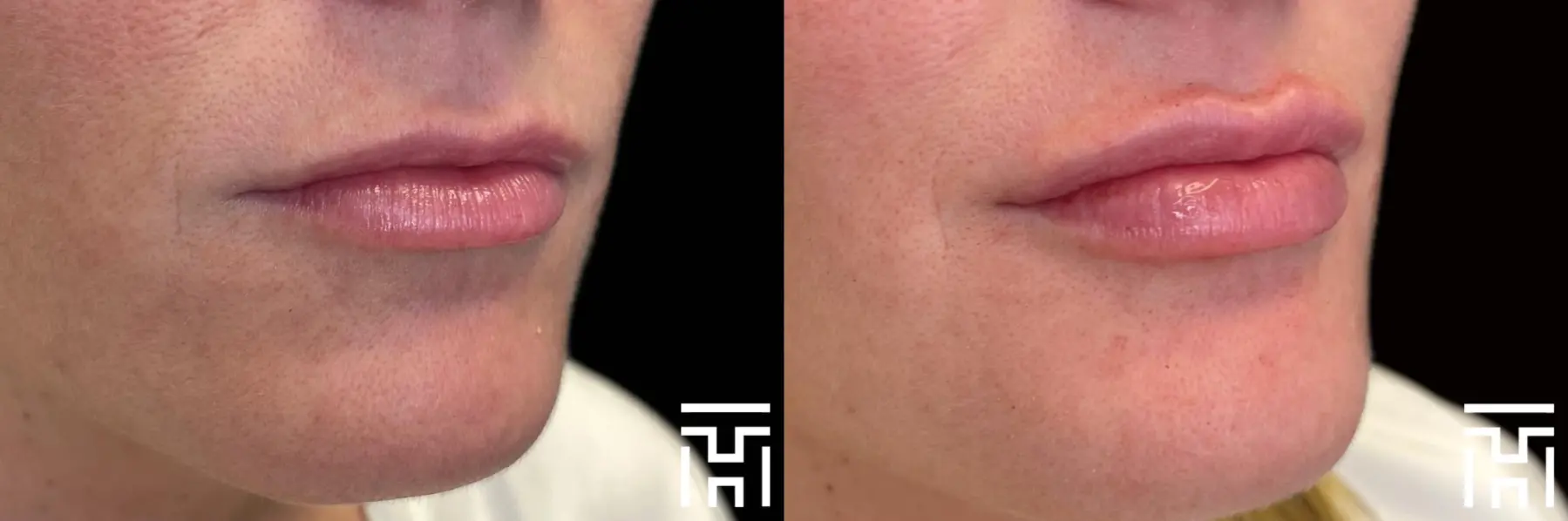 Lip Fillers: Patient 6 - Before and After  