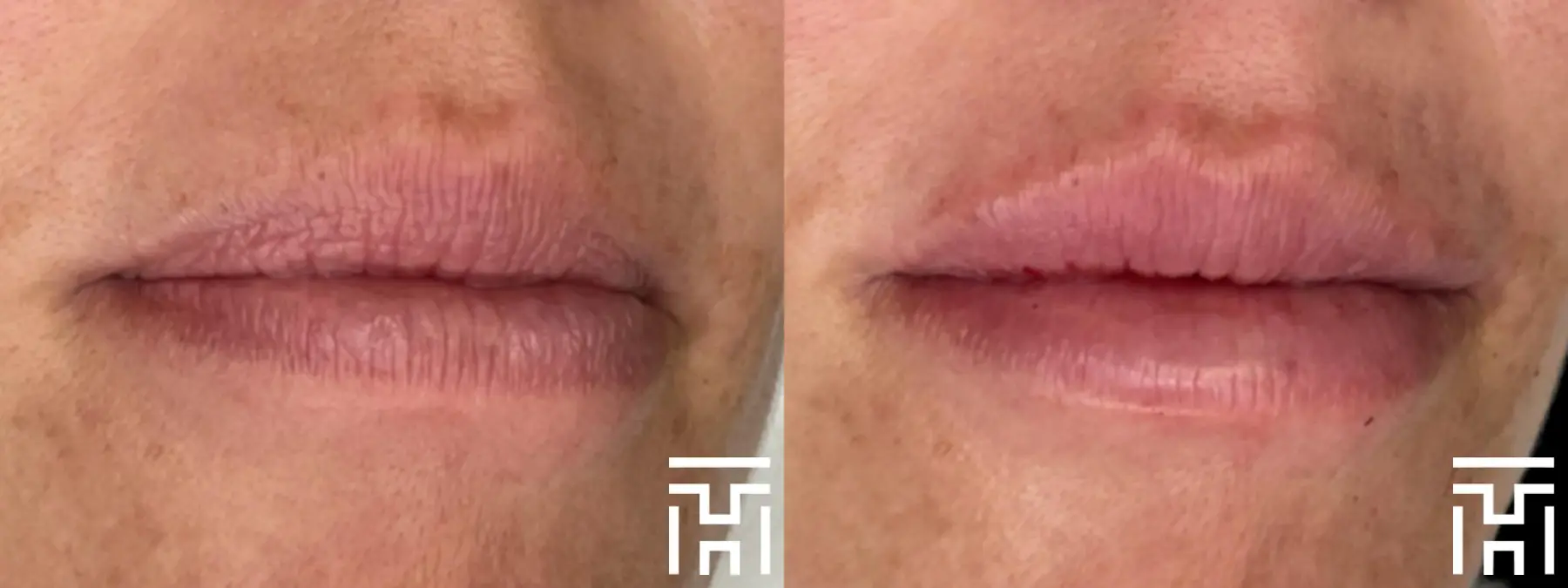 Lip Fillers: Patient 1 - Before and After  