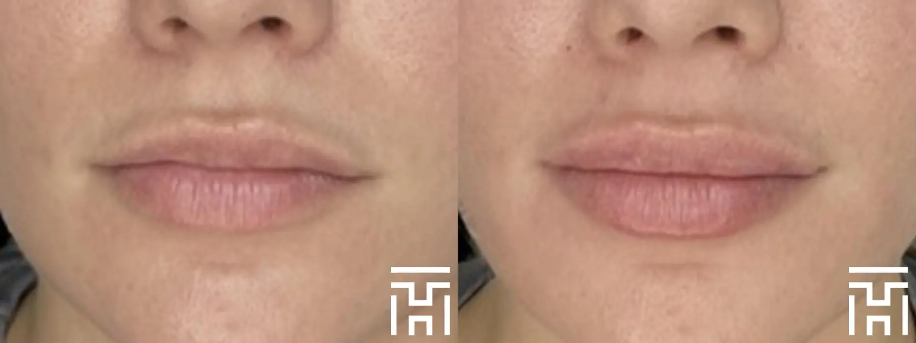 Lip Fillers: Patient 5 - Before and After  