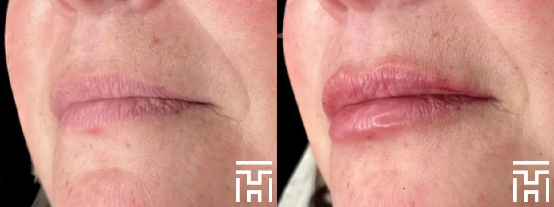 Lip Fillers: Patient 4 - Before and After  