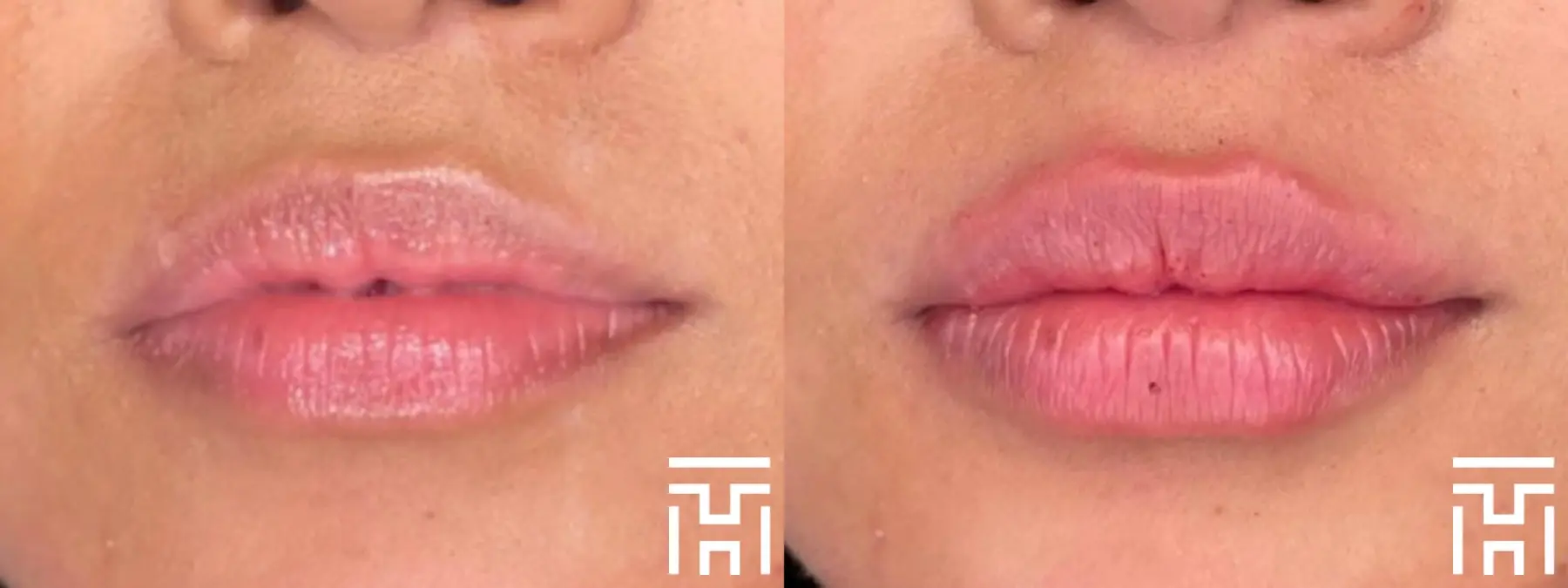 Lip Fillers: Patient 3 - Before and After  