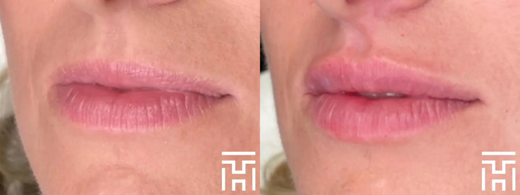 Lip Fillers: Patient 2 - Before and After  