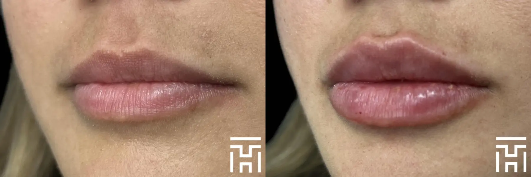 Lip Fillers: Patient 9 - Before and After  