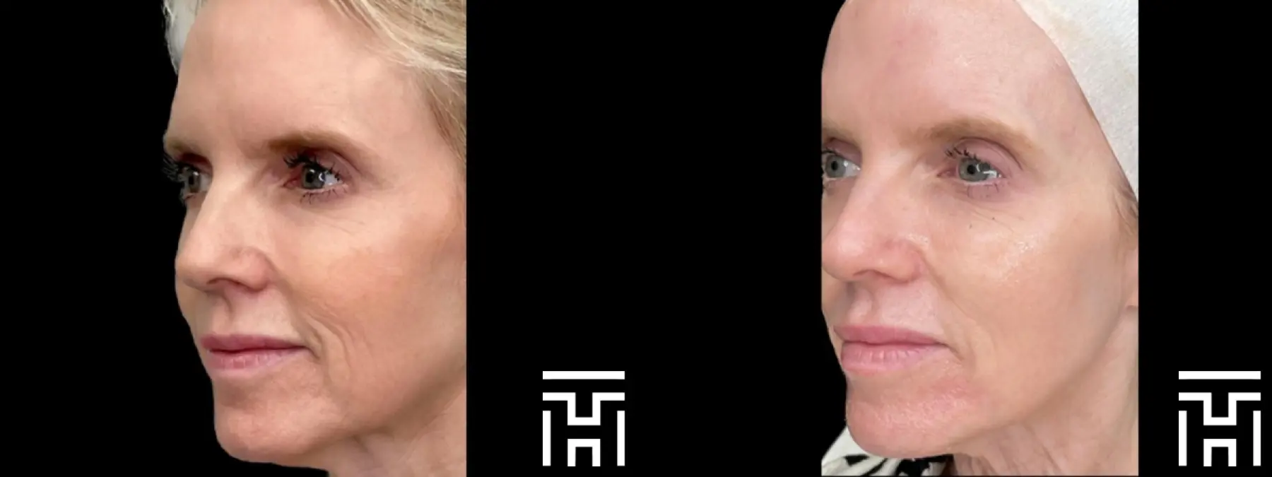 Sculptra®: Patient 1 - Before and After  