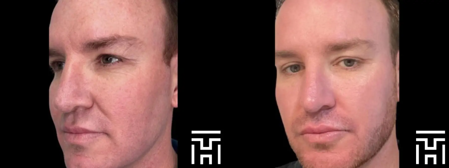 Trifecta: Patient 1 - Before and After  