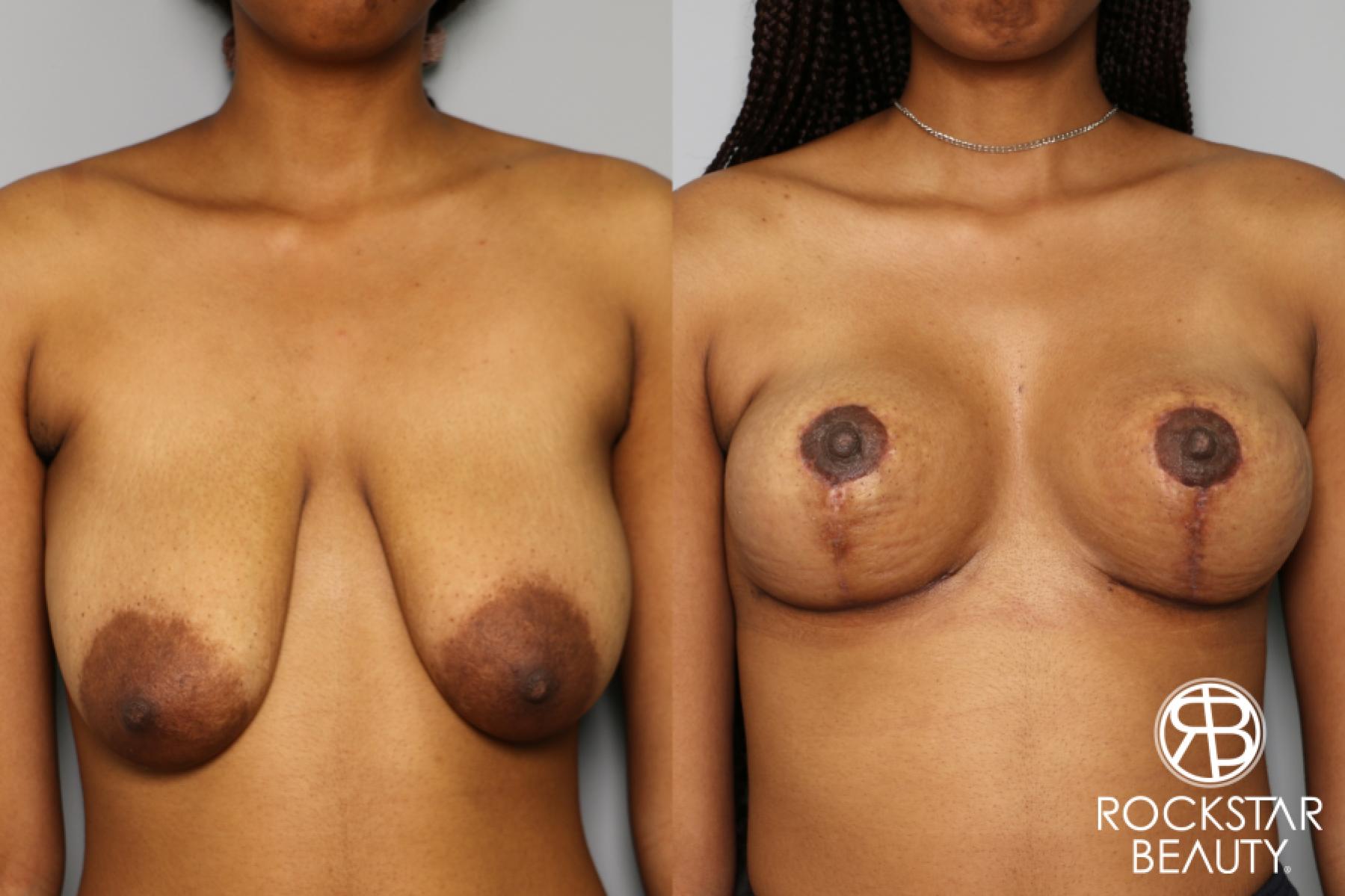 Breast Lift: Patient 3 - Before and After  