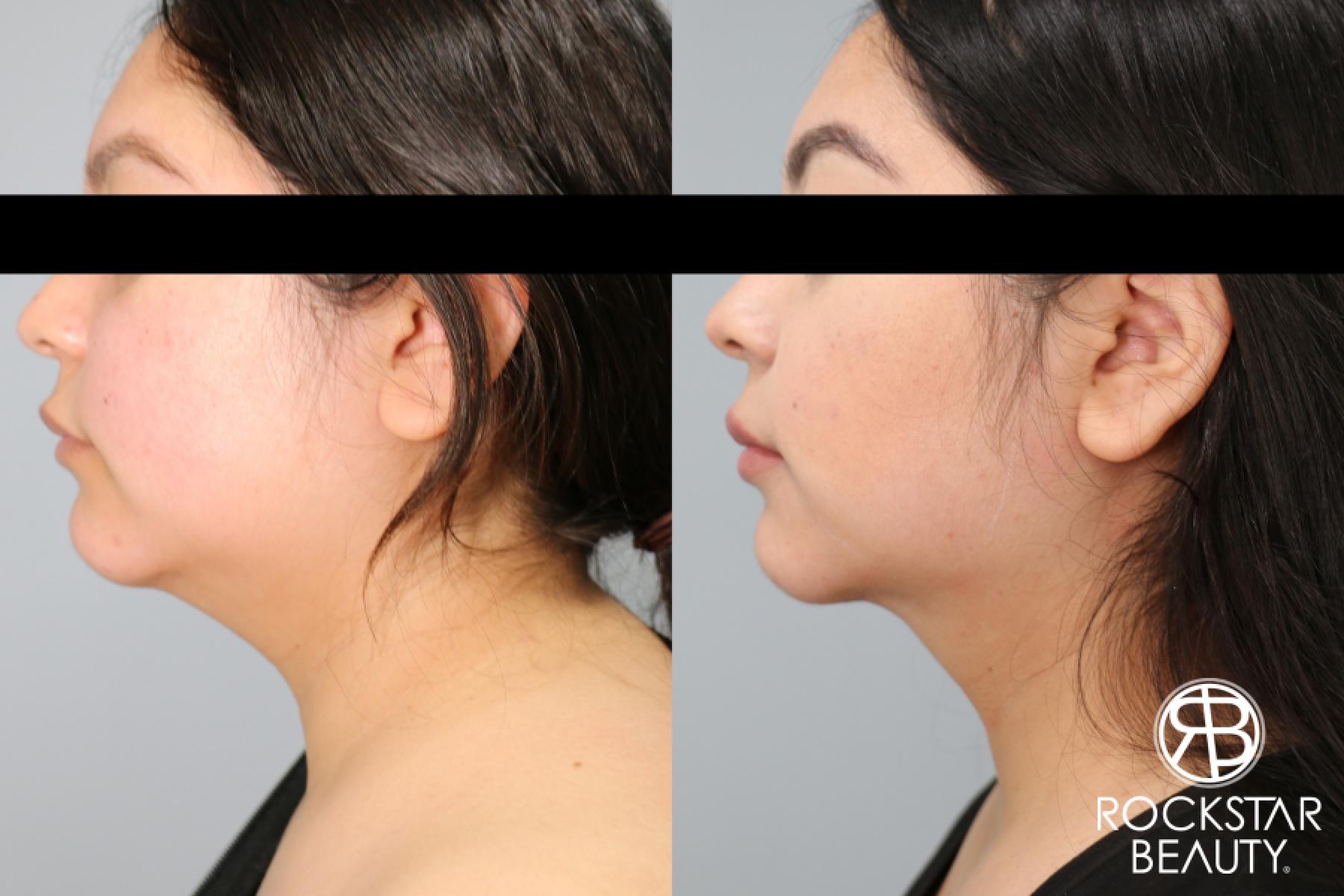 Liposuction Of The Neck: Patient 71 - Before and After 1