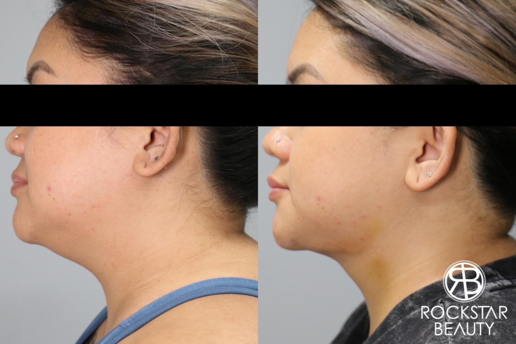 Liposuction Of The Neck: Patient 57 - Before and After 1