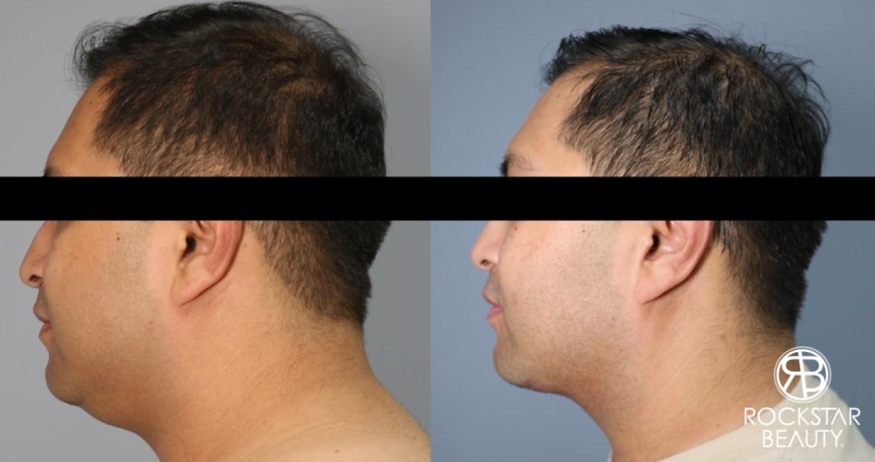 Liposuction Of The Neck: Patient 22 - Before and After 1