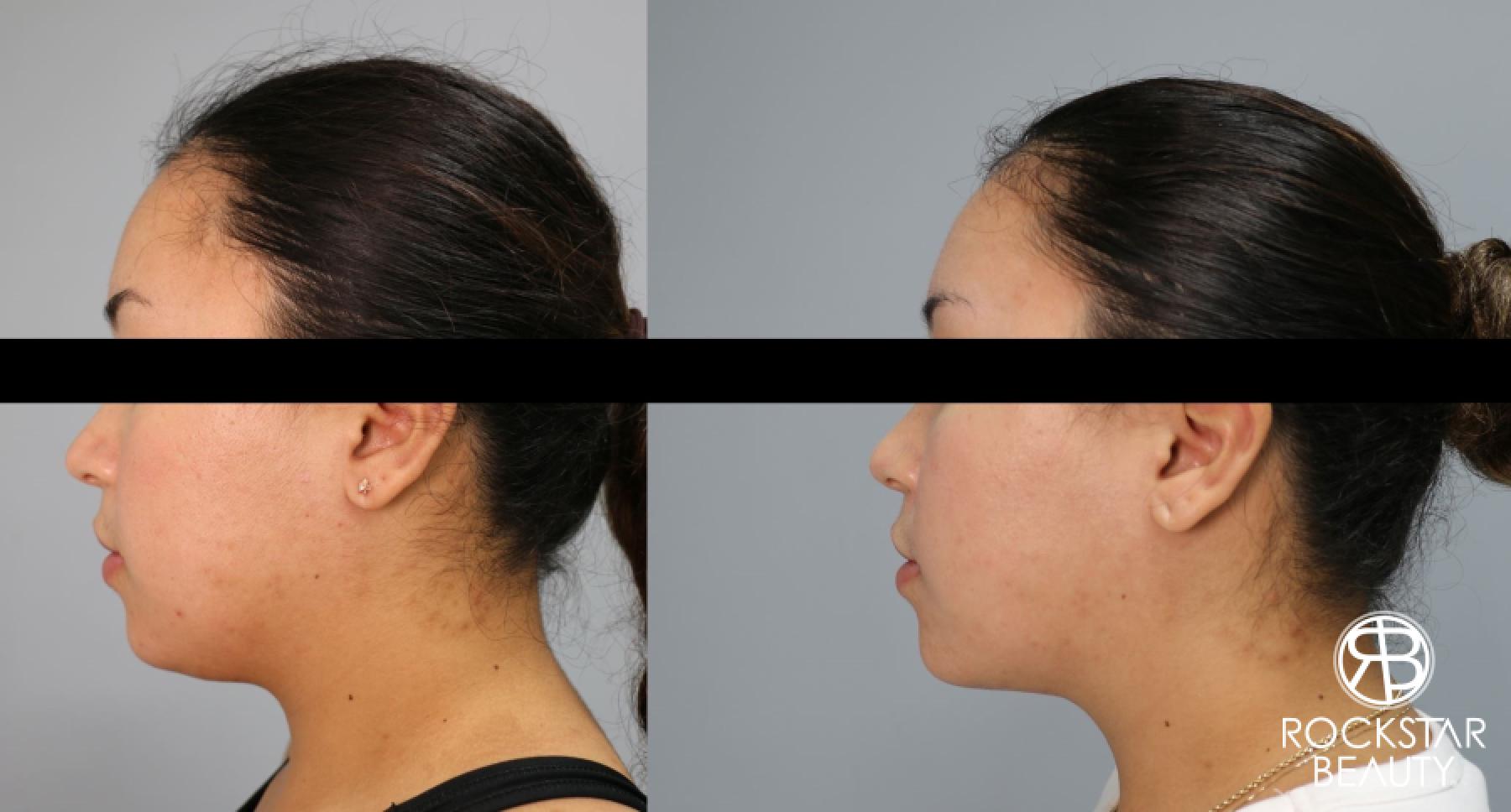 Liposuction Of The Neck: Patient 67 - Before and After 1