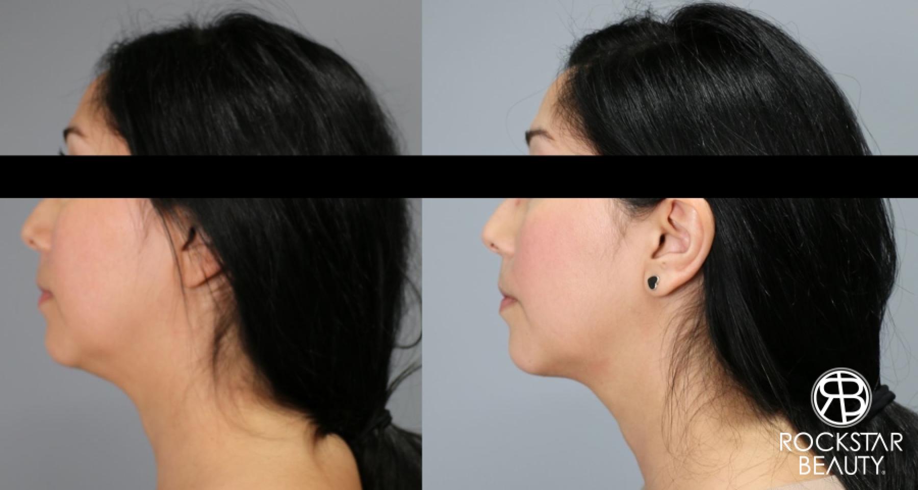 Liposuction Of The Neck: Patient 23 - Before and After 1