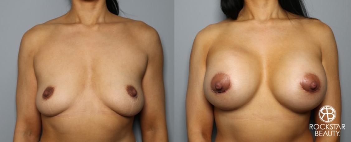 Breast Augmentation: Patient 32 - Before and After 1