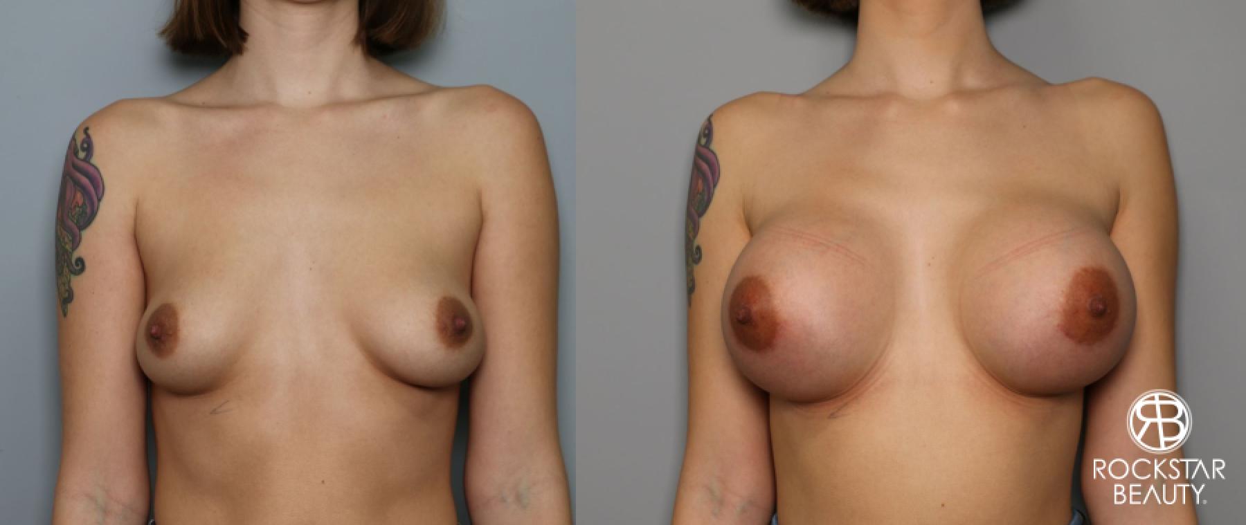 Breast Augmentation: Patient 22 - Before and After 1