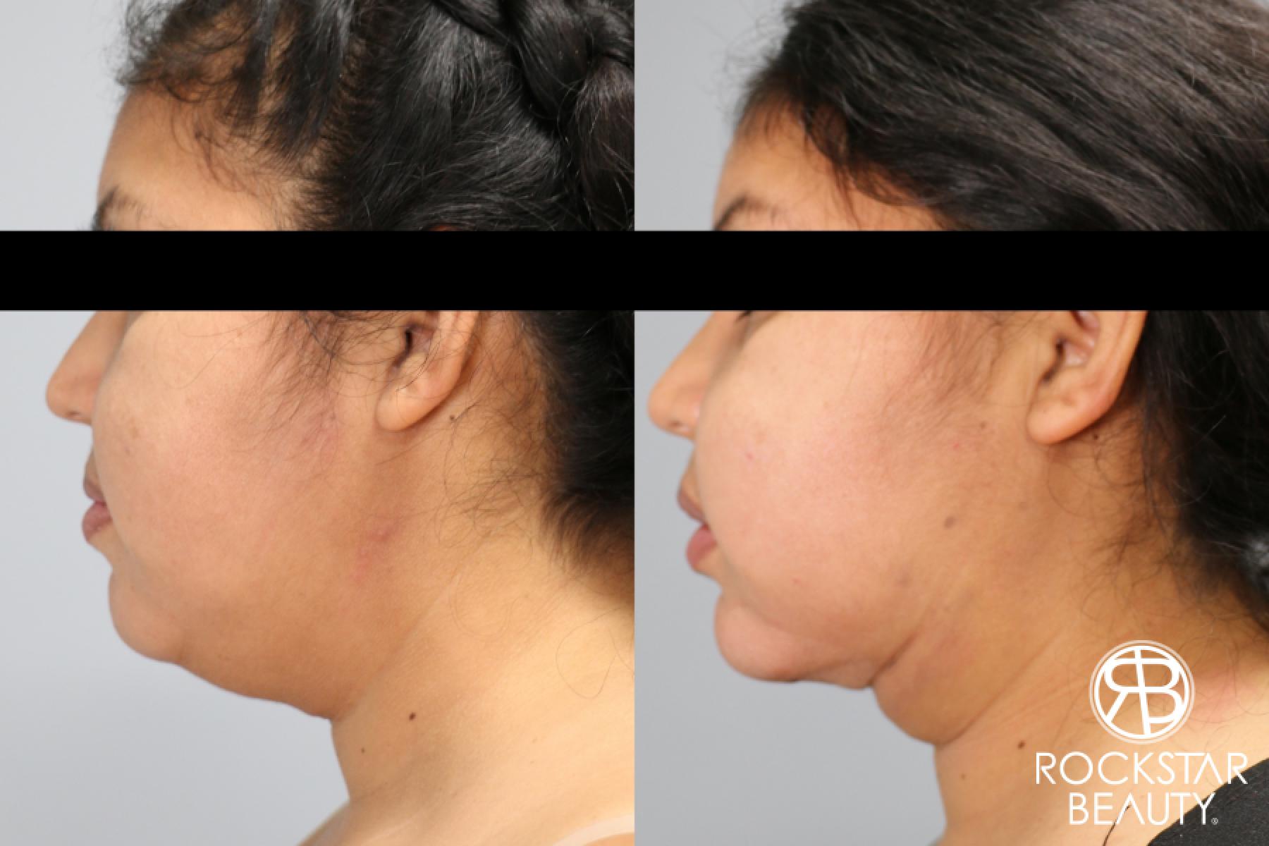 Liposuction Of The Neck: Patient 63 - Before and After 1